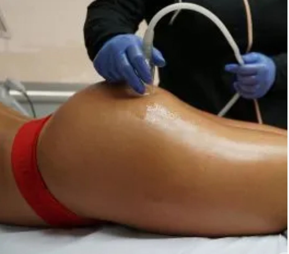 Non-Invasive Brazilian Butt Lift (9 Sessions)