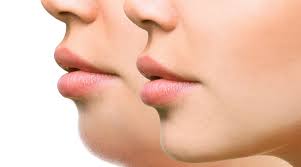 Fat Dissolving Treatments 6 Sessions (Arms and Chin)
